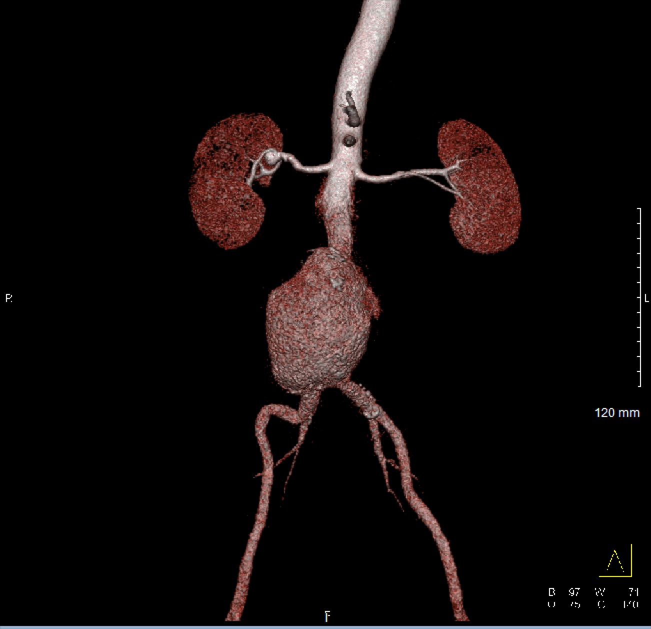 Abdominal Aortic Aneurysm EVAR
